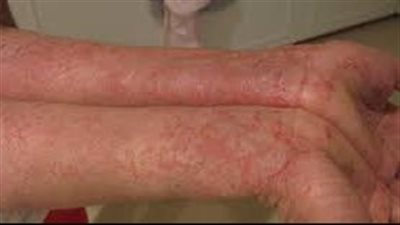 كيف تعد الإكزيما من الأمراض الجلدية المزعجة للغاية؟ (العلاج)