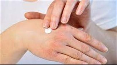 الإكزيما.. من الأمراض الجلدية المزعجة للغاية بسبب أعراضها المتمثلة في هذا الأمر