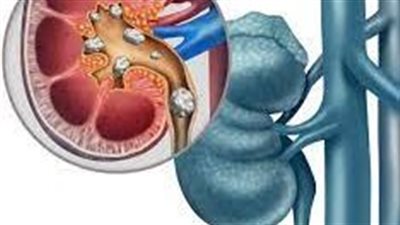  باحثون يكشفون طريقة لتفتيت حصى الكلى الكبيرة 