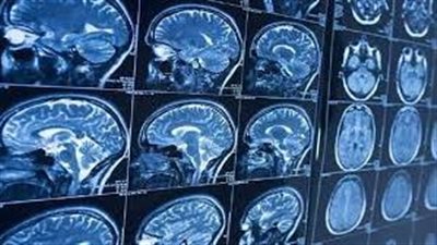 هل هناك وجود علاقة بين قيلولة النهار وخرف الزهايمر؟