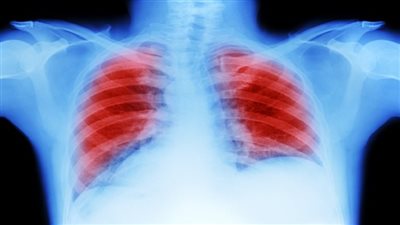  أكثر 10 سرطانات فتكا في الولايات المتحدة