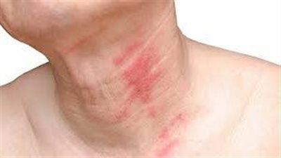 باحثون يطورون علاجًا باستخدام الجِل أو الهلام لمرض نادر