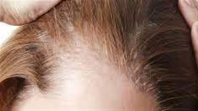 كل ما تريد معرفته حول أسباب الثعلبة