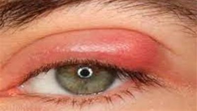 حكة الجفن.. من أعراض الإصابة بنوع نادر من السرطان