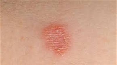 علاج يساعد الشفاء من مرض جلدي نادر