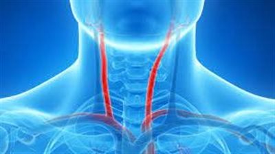  عوامل الإصابة بمرض تضيق الشريان السباتي.. تعرف عليها