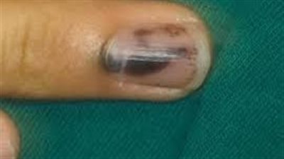 مفاجأة فاجعة.. سيدة من علامة بنية تحت ظفرها لـمدة 10 سنوات.. ماذا حدث؟