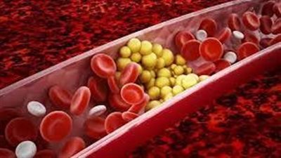  أبسط طريقة لتخفيض مستوى الكوليسترول في الجسم