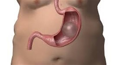  باحثون يقترحون تطوير عميلة زرع الدعامة أو البالون في المريء للتخسيس