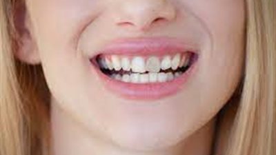 الأسباب الأكثر شيوعا لآفات البقع البيضاء على الأسنان