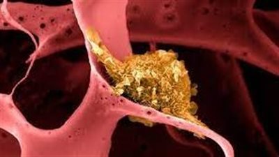 مادة تساعد على قتل خلايا أصعب أنوع سرطان الثدي