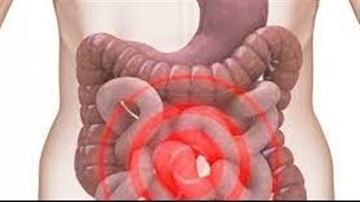 القولون العصبي وأعراضه تختلف من مريض لآخر.. فكيف تتعامل معه؟