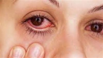 هربس العيون عدوى فيروسية تصيب العيون (الأسباب والأعراض)