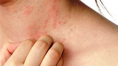 تعرف على الفرق بين حمو النيل والحساسية