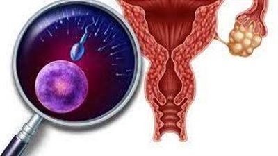 دراسة تبين خطأ التقديرات السابقة حول فاعلية تعقيم الرحم لمنع الحمل