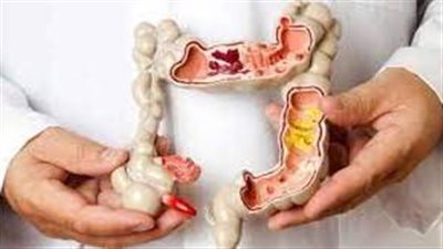 تعرف على أعراض الإصابة بسرطان الأمعاء