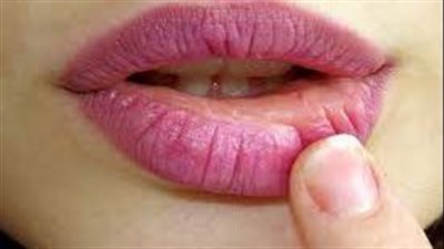 تصيب الشفاه.. حالة شائعة إذا تركت دون علاج فقد تكون خطيرة