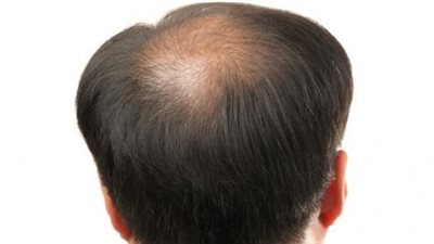  باحثون يتمكنون من ابتكار تركيبة دواء جديدة لإنتاج بصيلات الشعر