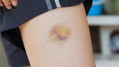 احذر.. الكدمات الكثيرة علامة على إصابة الطفل بمرض خطير