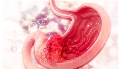 أعرض يجب الانتباه إليها في سياق مواجهة خطر سرطان المعدة