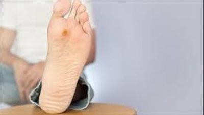 الخبراء ينصحون بإلقاء نظرة فاحصة على القدمين كل يوم لاكتشاف أي تغييرات (الأسباب)
