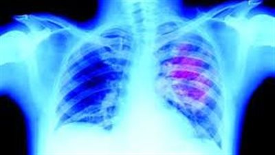 باحثون يتوصلون لجين يقاوم سرطان الرئة