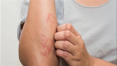  دراسة: الاكزيما ترتبط بزيادة خطر الاكتئاب أو القلق بنسبة 63% خاصة لدى المراهقي