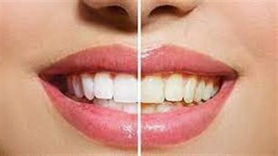 حيلة بسيطة لتبييض الأسنان باستخدام 3 مكونات منزلية دون اللجوء إلى المواد الكيماوية 