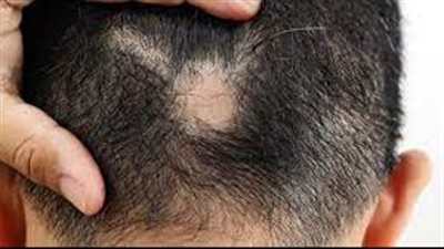 متى يبدأ داء الثعلبة عادة؟