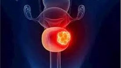 الكشف علاج جديد لمرض سرطان المثانة