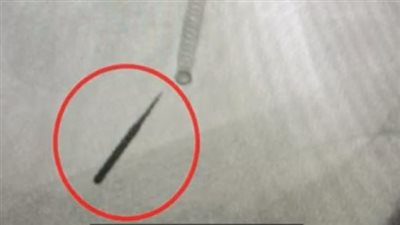 واقعة نادرة.. مريض يبتلع عن طريق الخطأ مثقاب أسنان