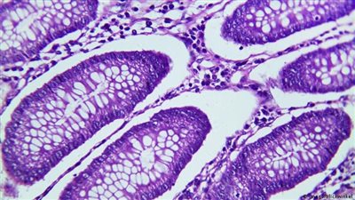  باحثون يكشفون تدابير بسيطة في محاولة لتقليل خطر الإصابة بالسرطان بحوالي الثلثين