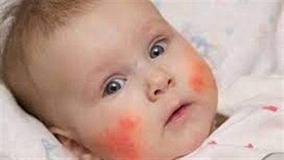 دراسة جديدة تكشف أن علاجات العقم تزيد احتمال إصابة الأطفال بالأكزيما والربو