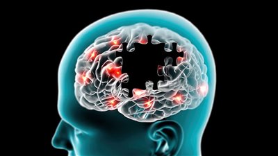 تفاصيل أول زراعة دماغ تعكس أعراض الباركنسون