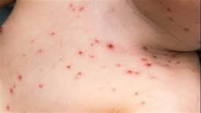 مجددًاَ.. تفشي مرض الحصبة بين الأطفال