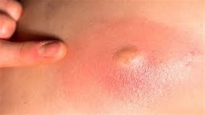 تعرف على أسباب نشوء الخرّاج