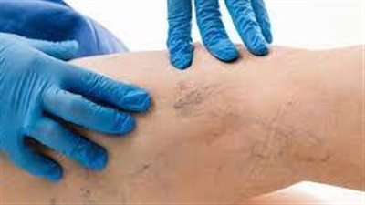 كيفية التخلص من الأوردة العنكبوتية