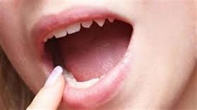 حالات من البقع الملونة على اللسان يمكن أن يشير كل لون إلى وجود مرض ما