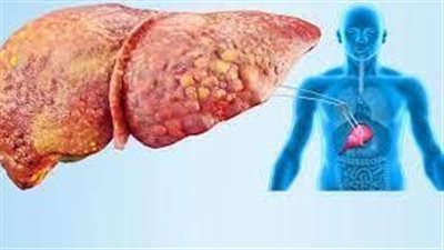 كيف يساعد التقليل من تناول فيتامين В3 والفواكه في الحفاظ على الكبد بحالة صحية جيدة؟
