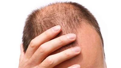  لماذا يقتل مرض كورونا في كثير من الأحيان الرجال الصُلع؟