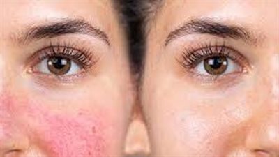 ماذا يعني احمرار البشرة المستمر؟