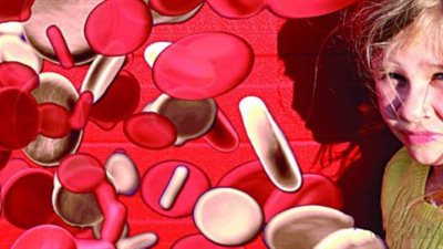 الثلاسيميا الاضطراب أحادي الجين الأكثر شيوعا في العالم (علاجاته)