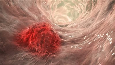  عقار يثبط نمو الأورام السحائية الأكثر عدوانية