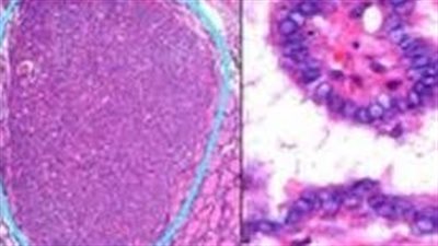  دراسة جديدة: دهون البطن تضاعف خطر إصابة النساء ببعض أنواع السرطان
