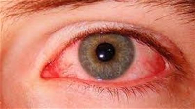 محافظة ذي قار جنوب العراق تسجل حالة وفاة بالحمى النزفية