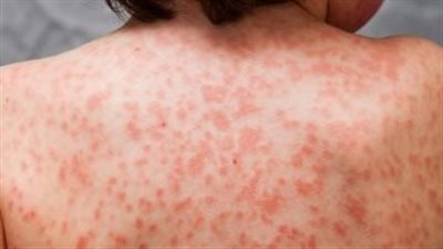  العلامات الخمس لعدوى قاتلة ما يعني أنك بحاجة إلى الحصول على المساعدة على الفور