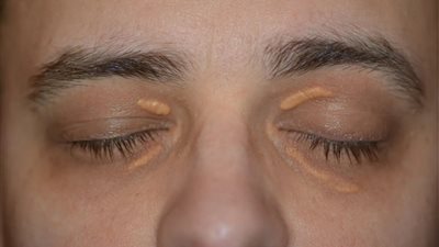  خبيرة تغذية روسية.. ماذا يعني ظهور لويحات حول العين؟