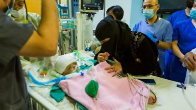 في عملية استغرقت 15 ساعة.. نجاح فصل التوأم اليمني 