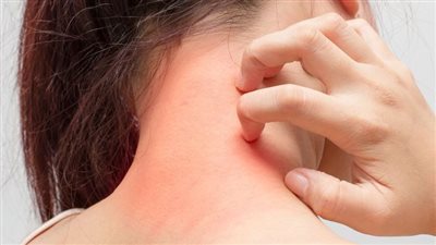  التهاب الجلد العصبي كثيرًا ما يسلب النوم من أعين الأطفال المصابين به (الأسباب)