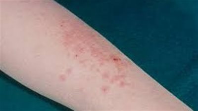  زيادة كبيرة للإصابة بمرض الطفح الجلدي الوردي في ماليزيا